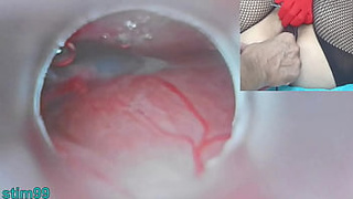 Oriental Insemination with Jizz into Uterus and Endoscope Online cam by Cervix to watch inside womb Uncensored
