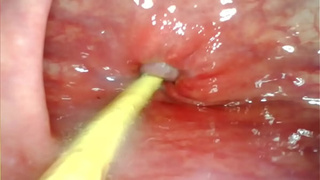 EXTREME ANAL SELF PERSPECTIVE. WEB-CAM INSIDE HER BUTT-HOLE AS I POUND HER WITH MY GIGANTIC DICK AND SPERM DEEP INSIDE